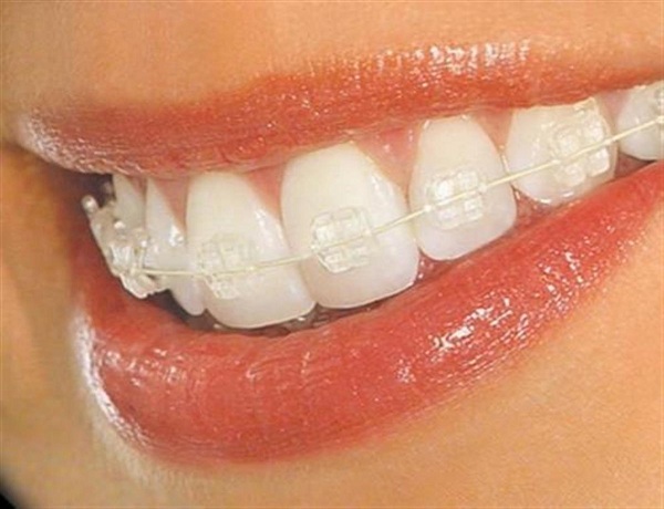 Best Smile Turkey - Orthodontics